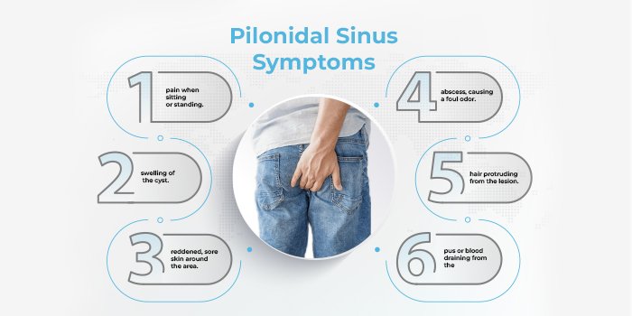 pilonidal-sinus-treatment-without-surgery